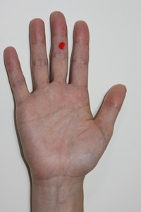 橋本病の高麗手指鍼のツボの位置